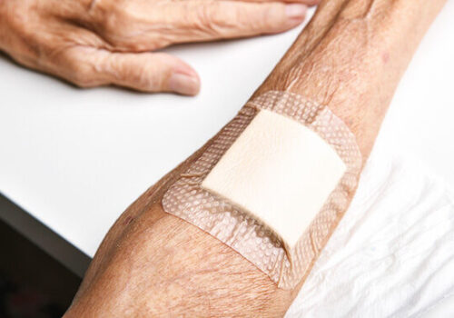 How this PCN... set up a skin tear pilot