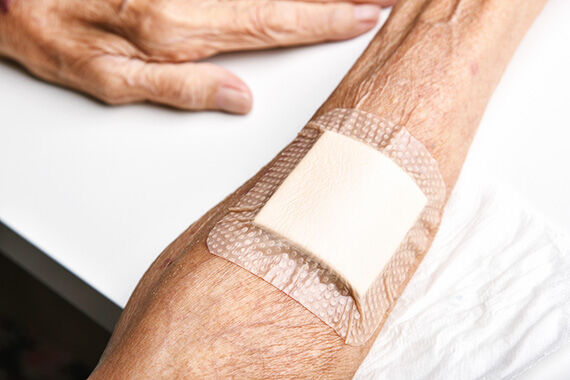 How this PCN... set up a skin tear pilot