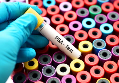 |Chapelford medical centre prostate cancer